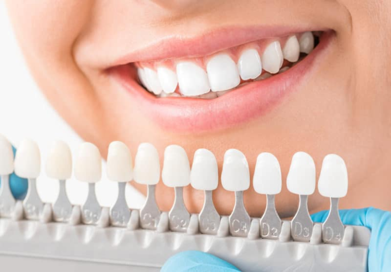Dental Veneers vs Tooth Whitening: Which Option Suits You? veneers